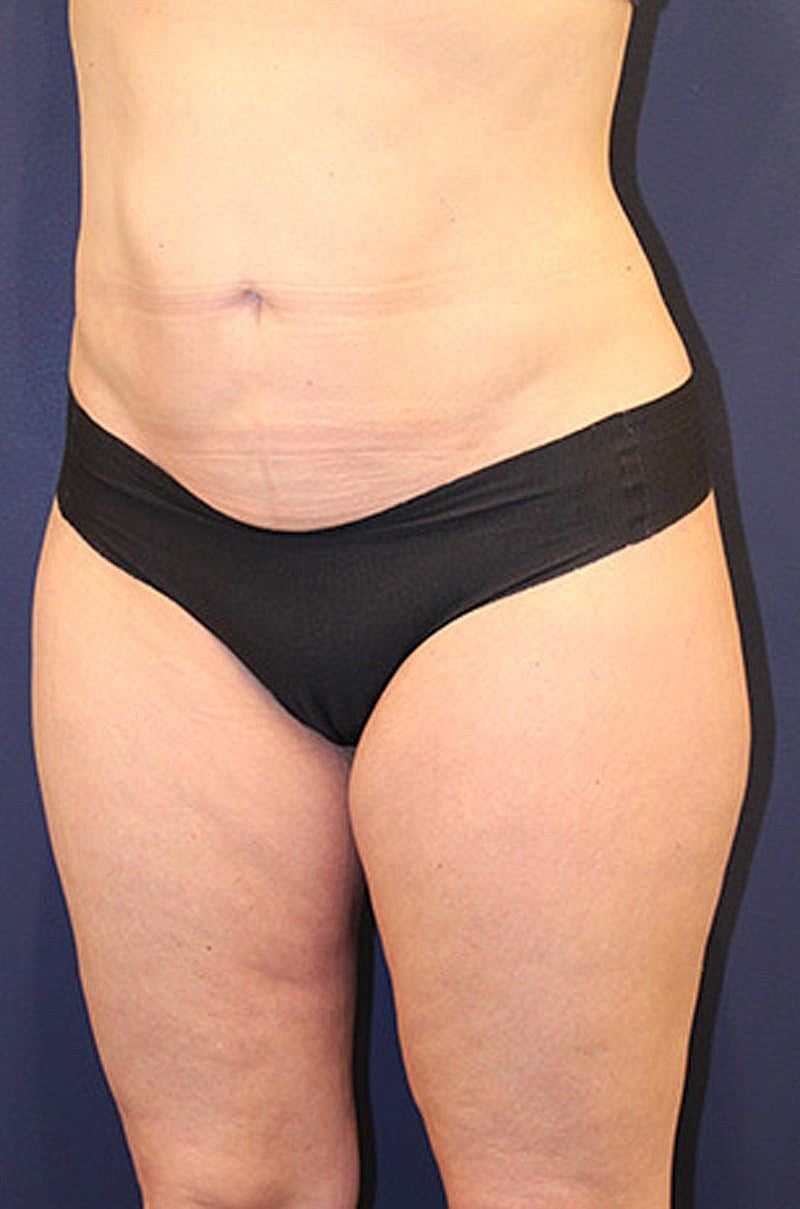 Liposuction Before & After