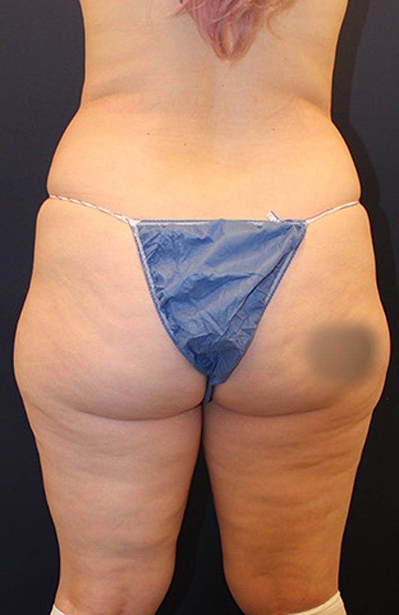 Liposuction Before & After