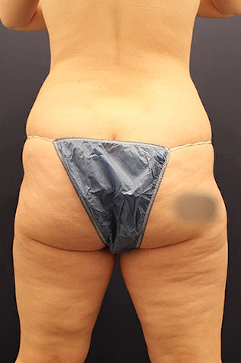 Liposuction Before & After