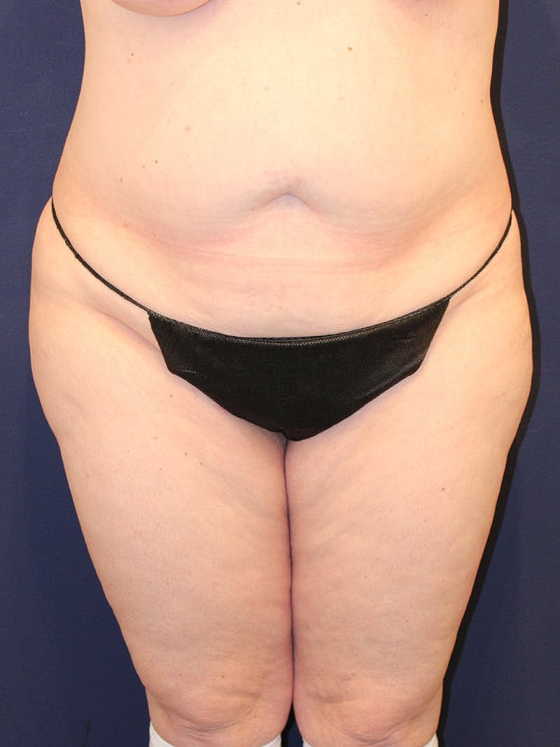 Liposuction Before & After