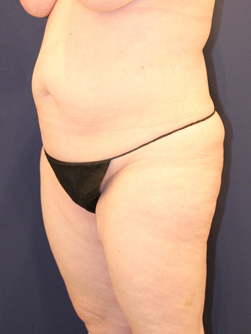 Liposuction Before & After