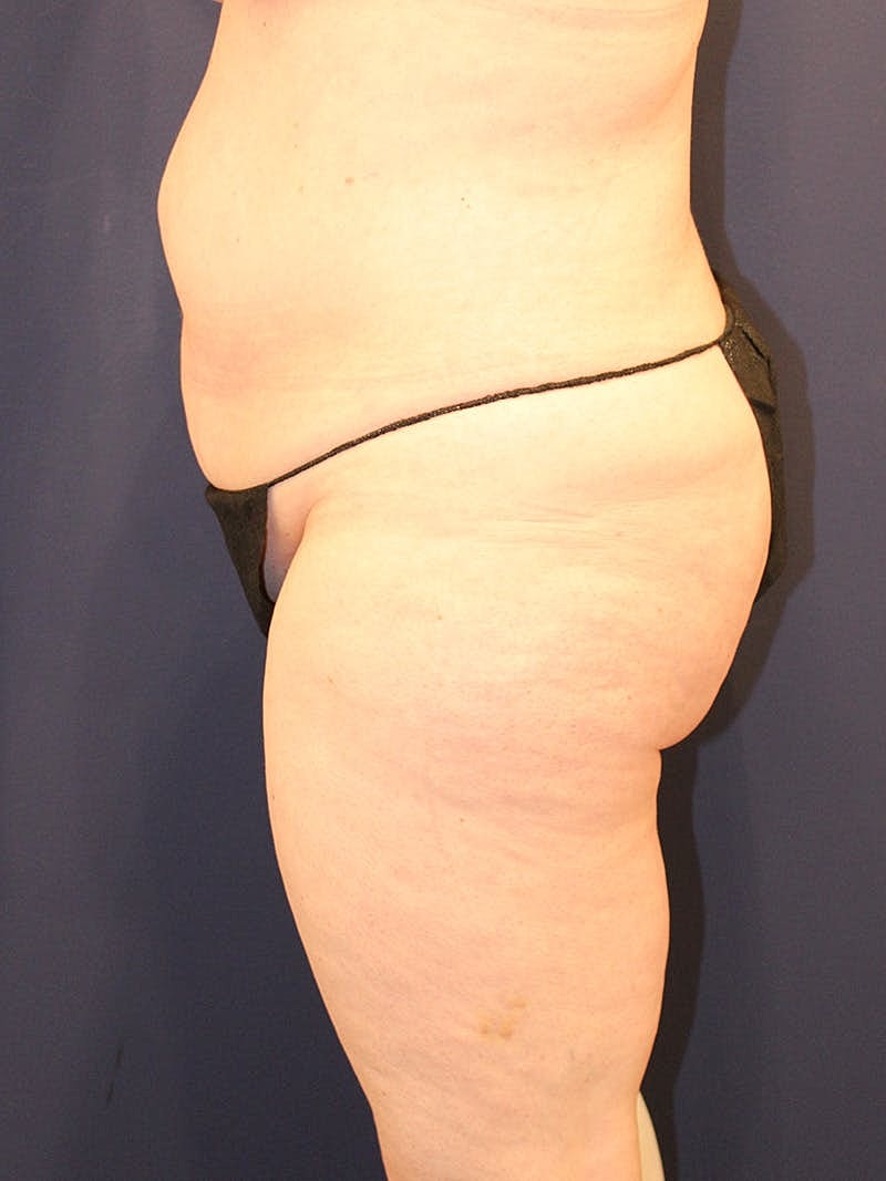 Liposuction Before & After