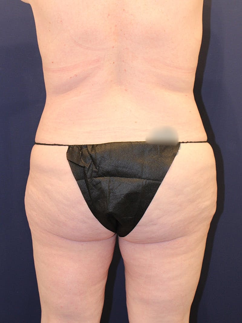 Liposuction Before & After
