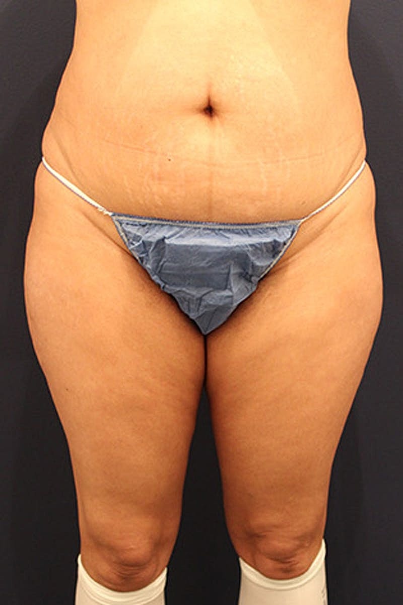 Liposuction Before & After