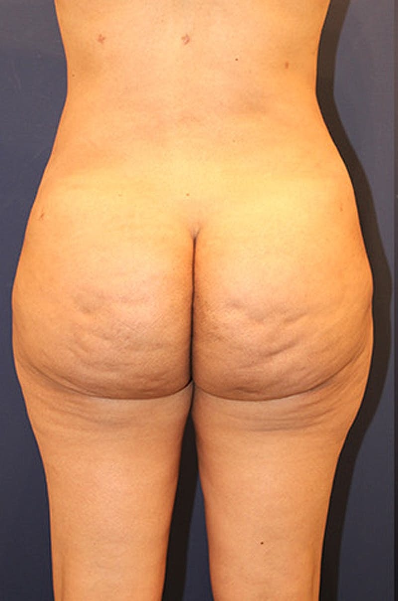 Liposuction Before & After