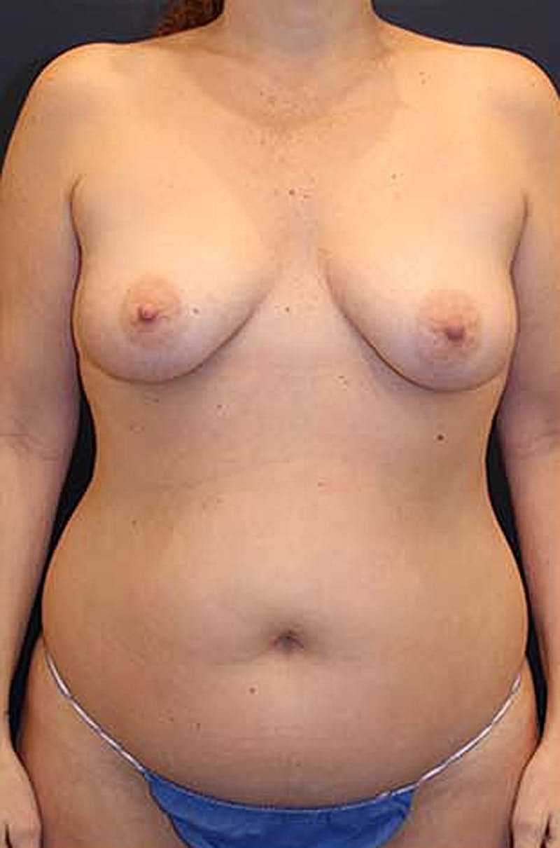 Liposuction Before & After