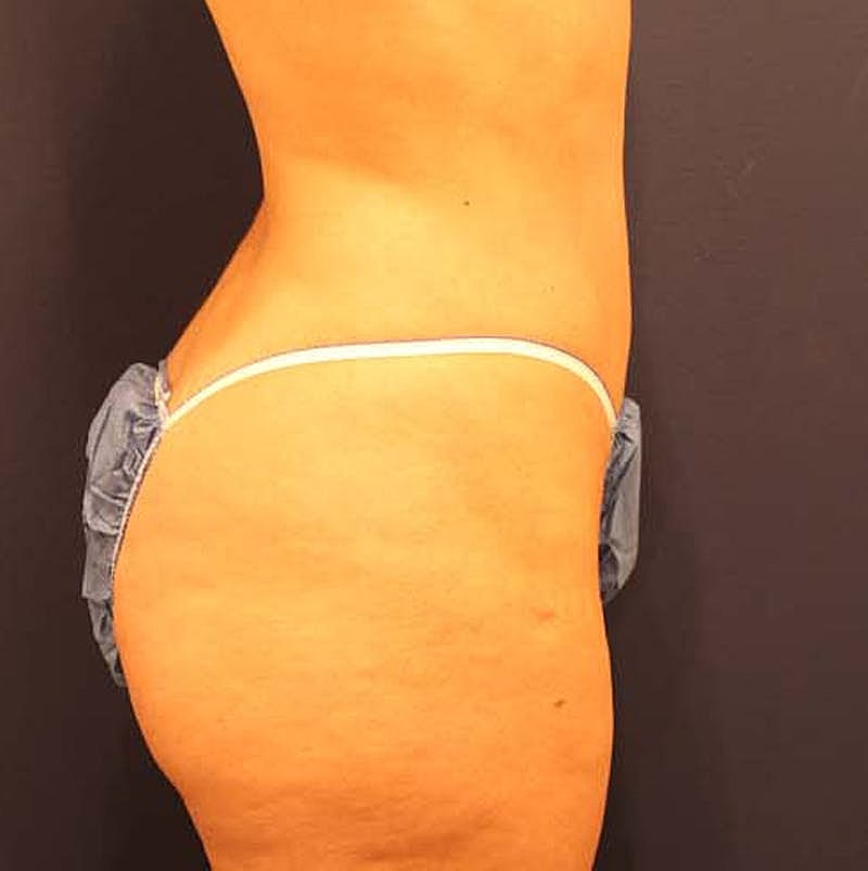 Liposuction Before & After