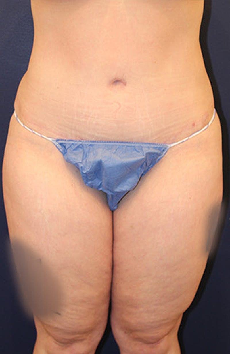 Liposuction Before & After