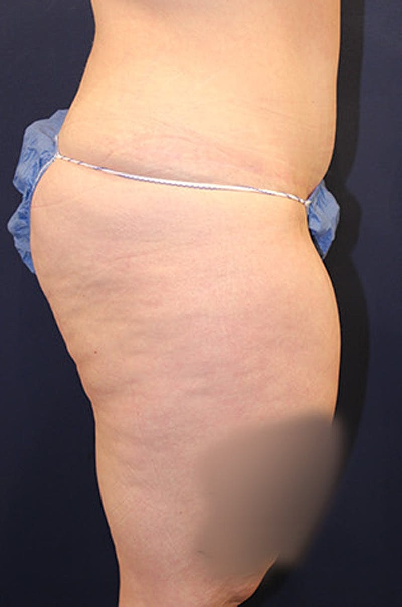 Liposuction Before & After