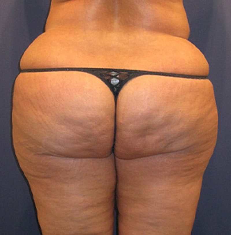Liposuction Before & After