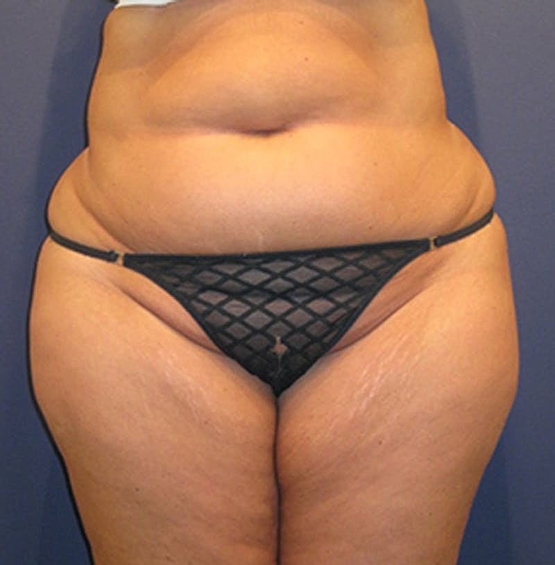 Liposuction Before & After