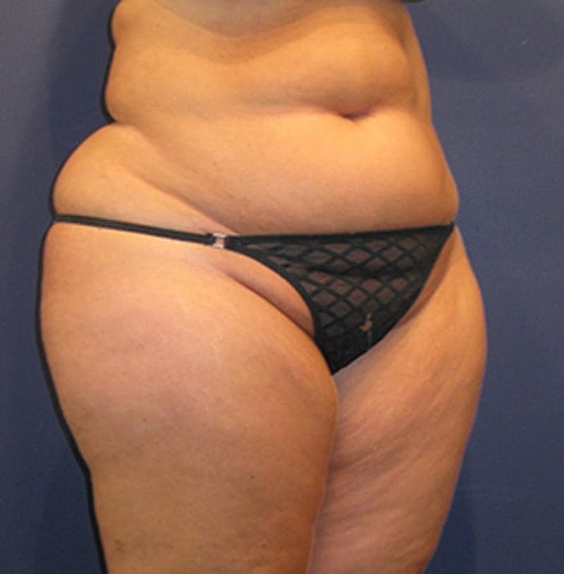 Liposuction Before & After