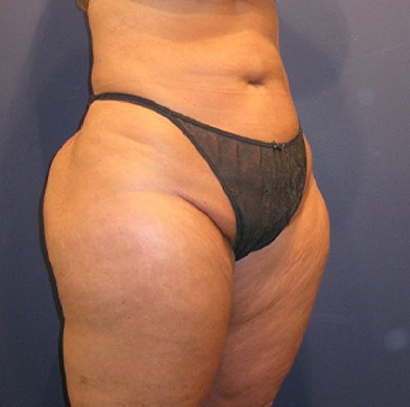 Liposuction Before & After