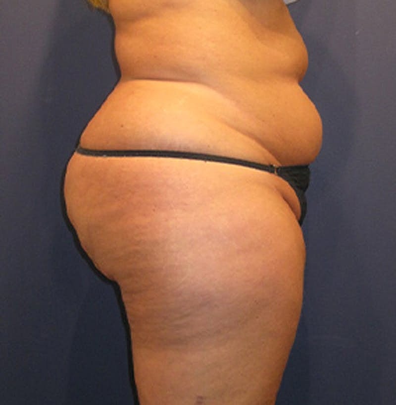 Liposuction Before & After