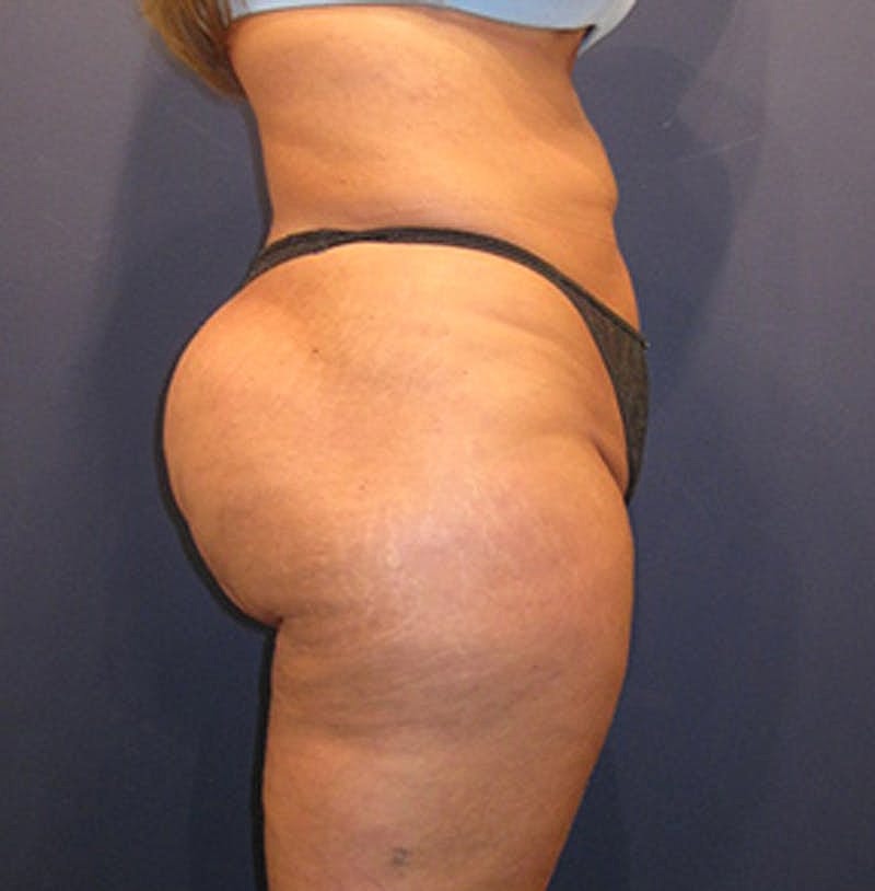 Liposuction Before & After
