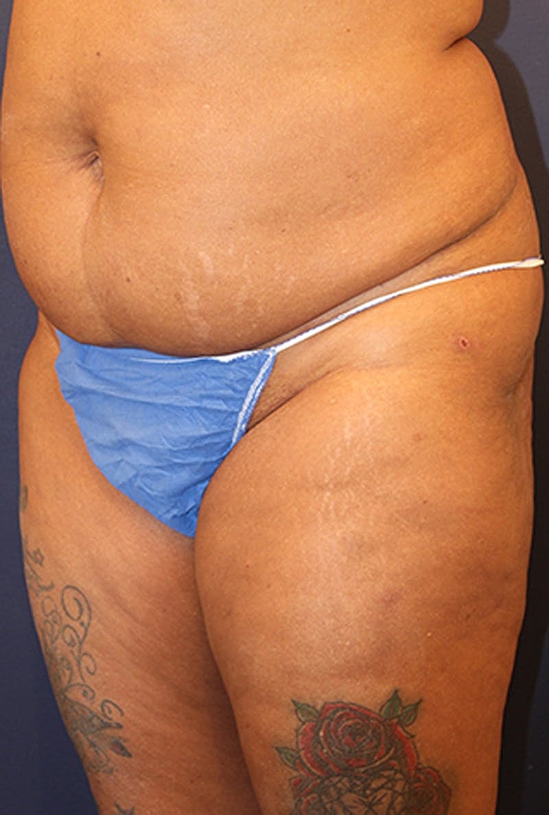 Liposuction Before & After