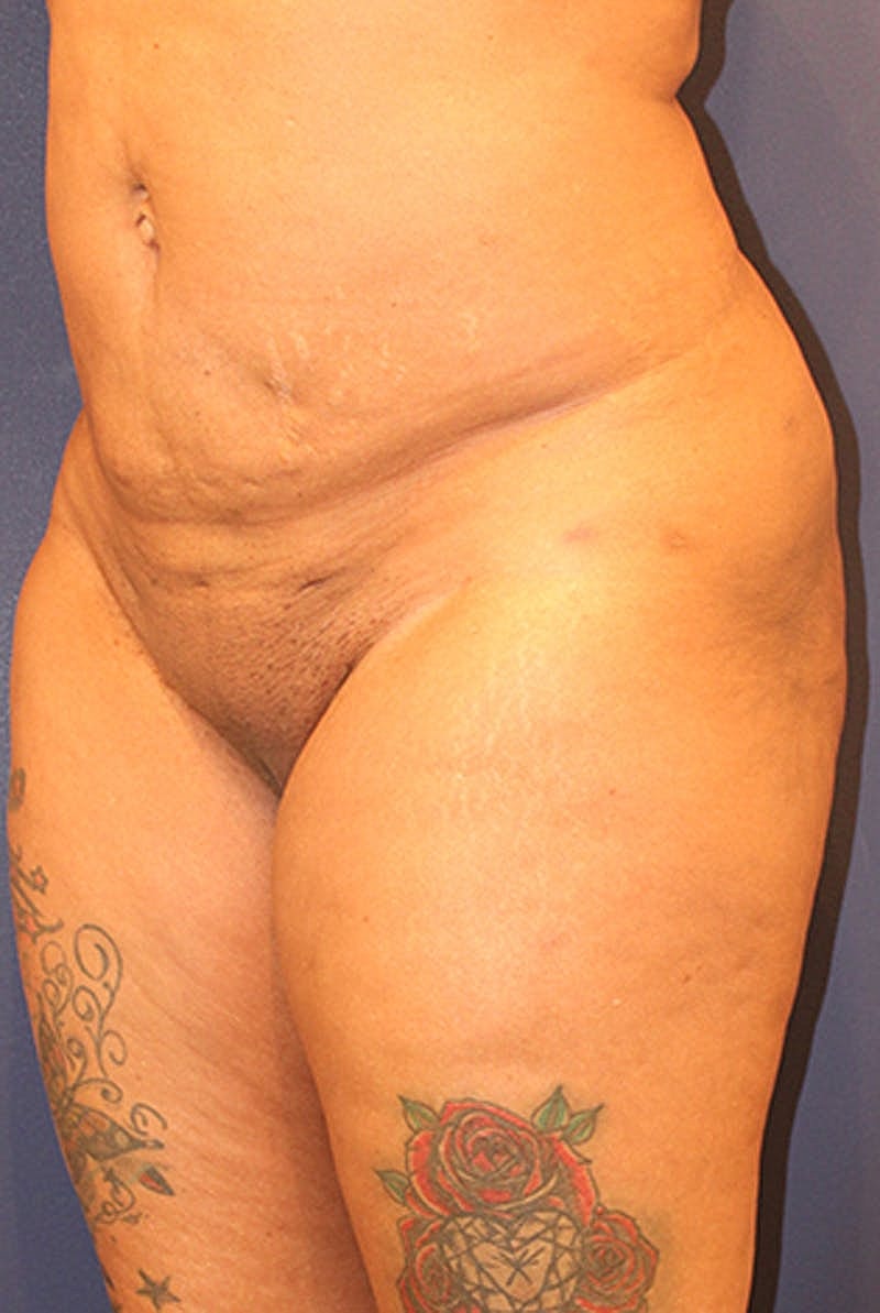 Liposuction Before & After