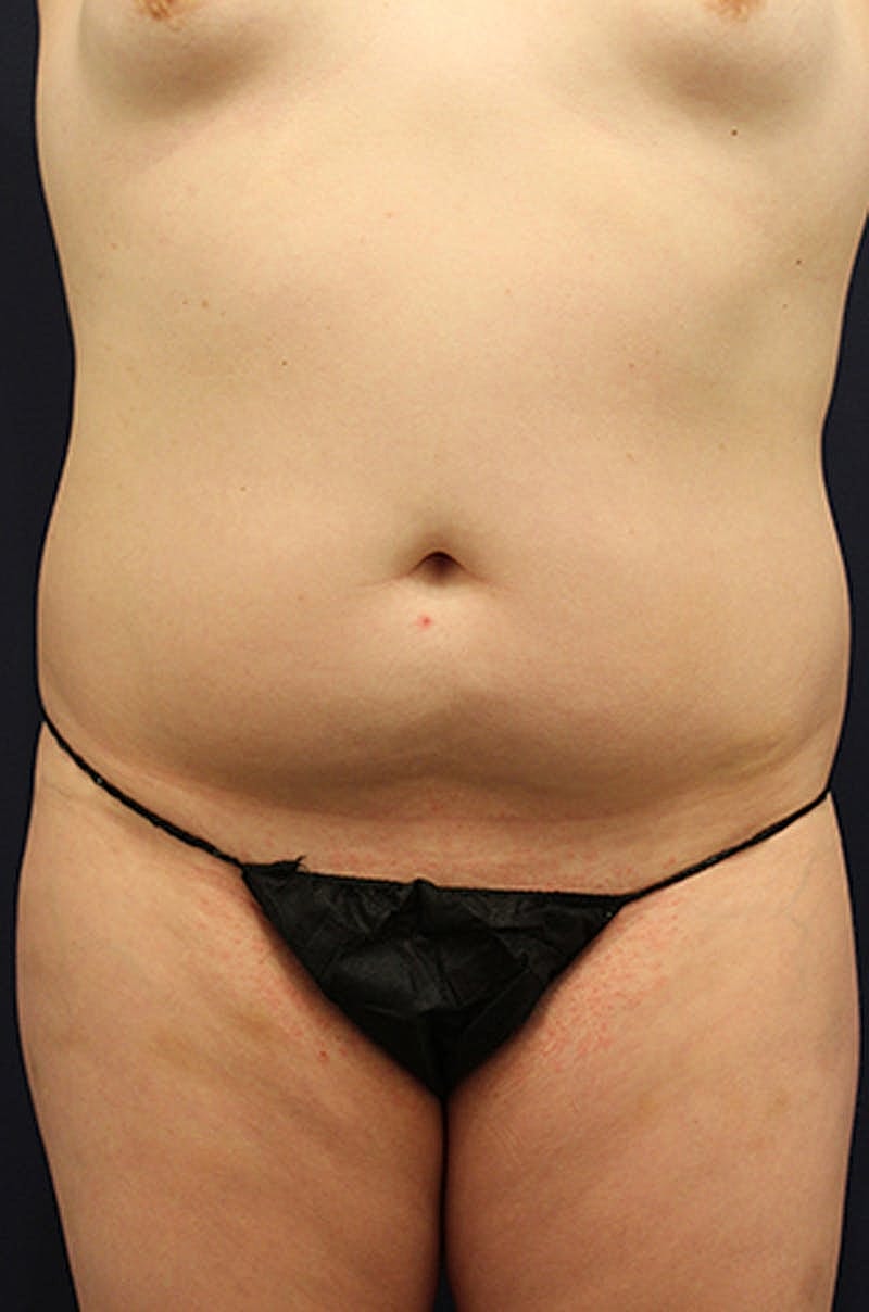 Liposuction Before & After