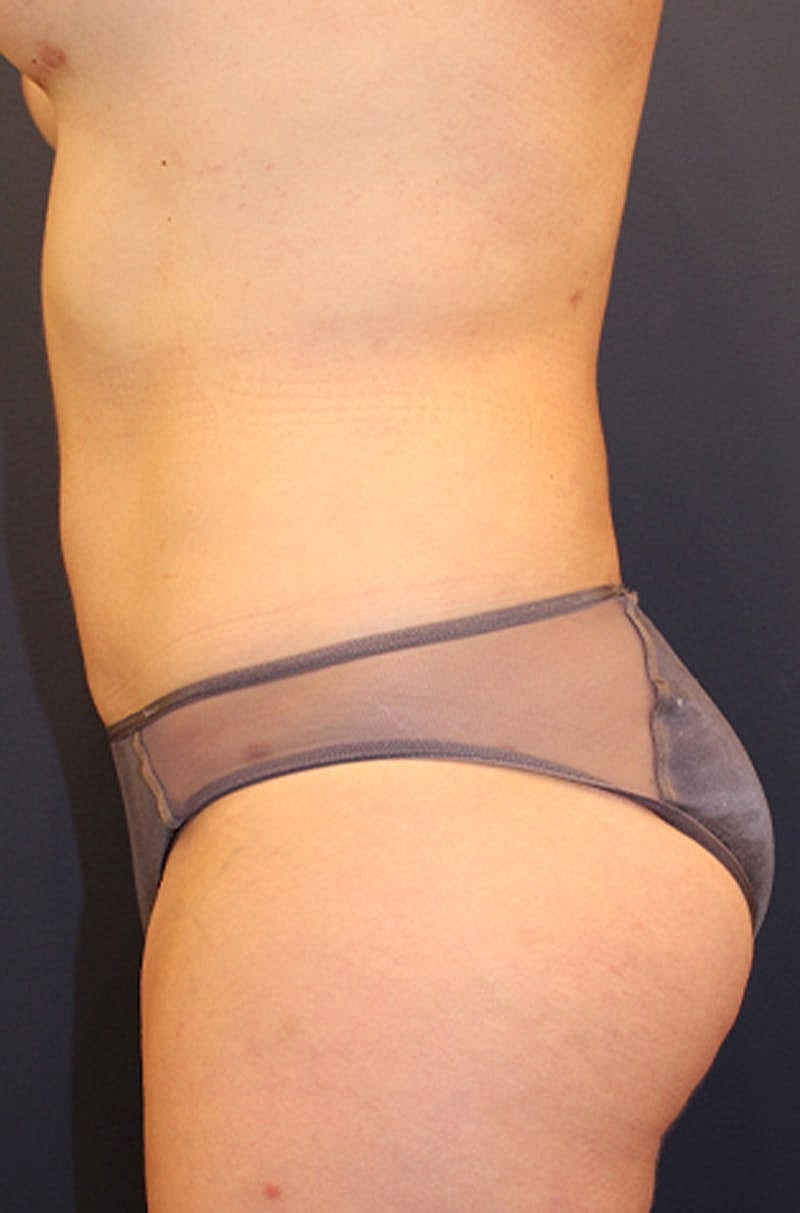 Liposuction Before & After