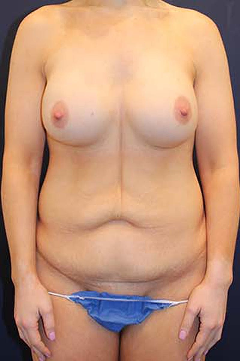 Liposuction Before & After