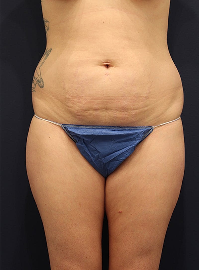 Liposuction Before & After