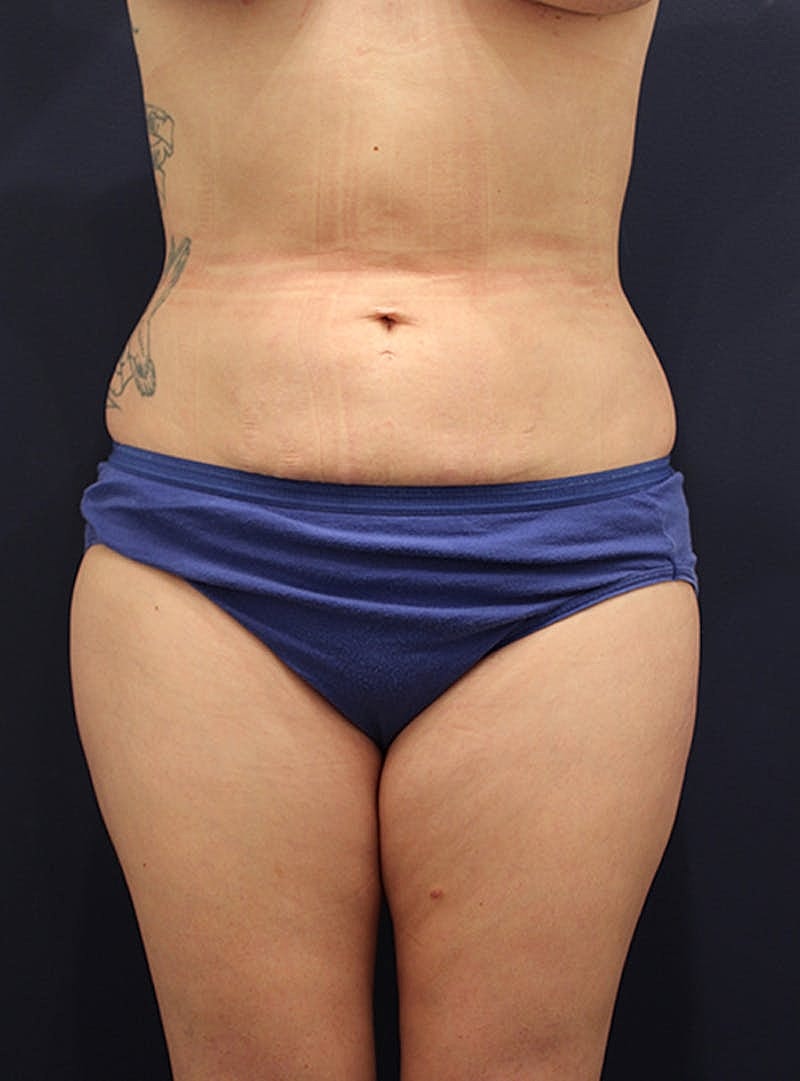 Liposuction Before & After