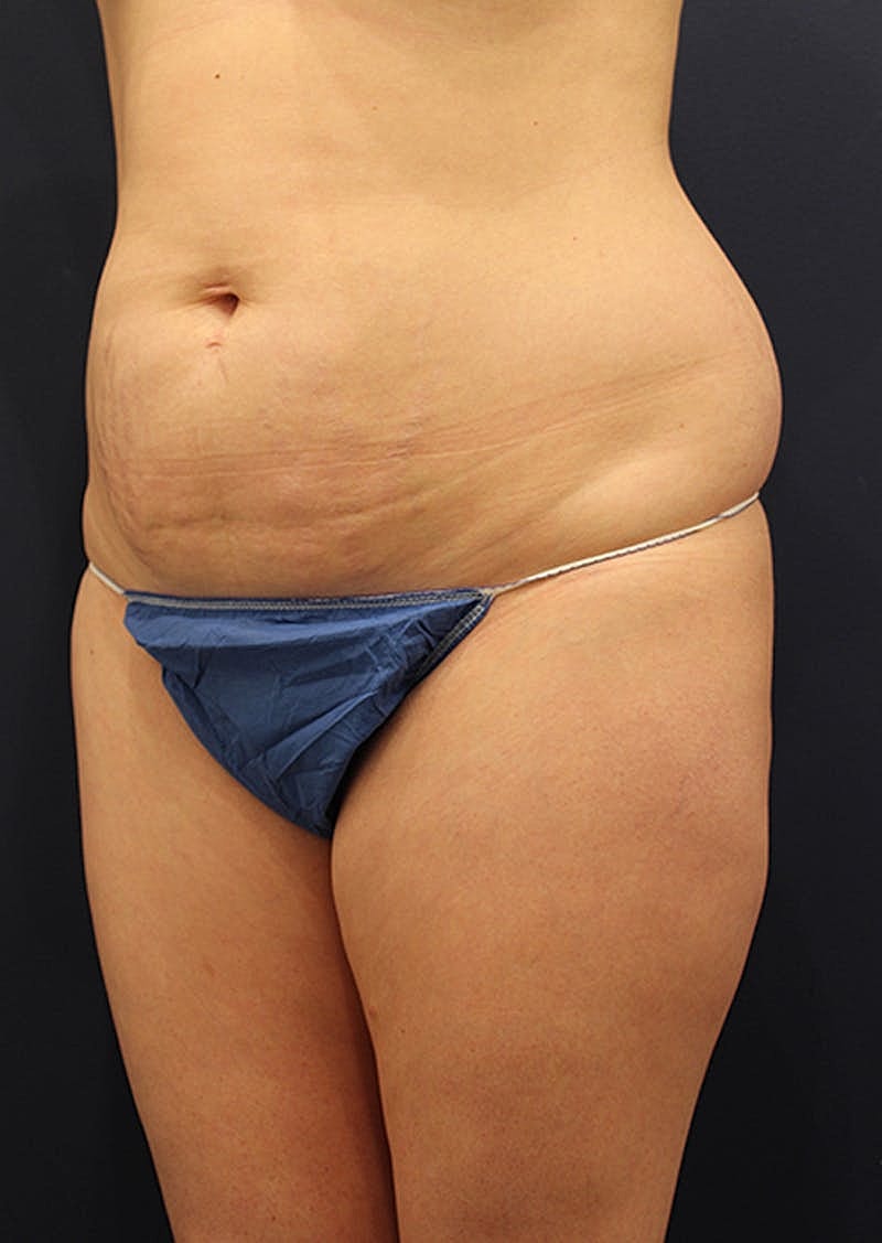 Liposuction Before & After