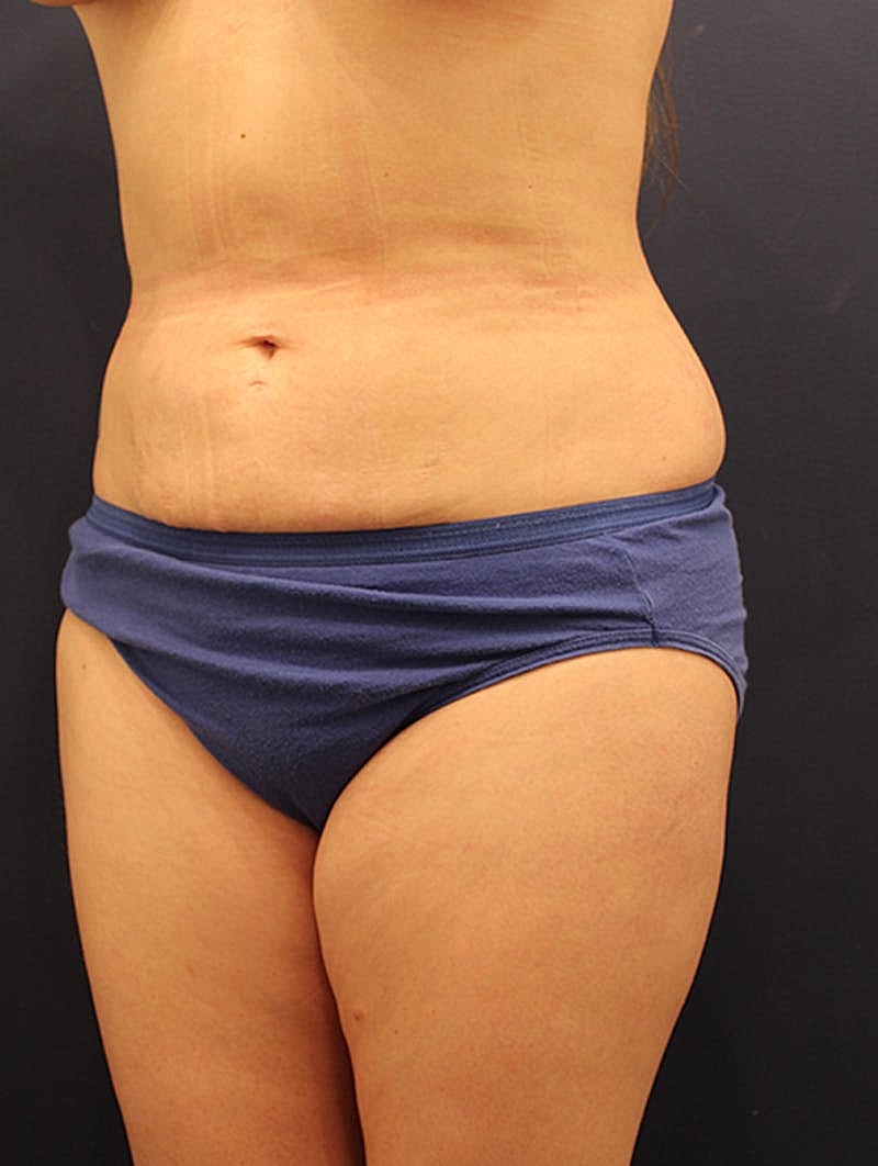 Liposuction Before & After