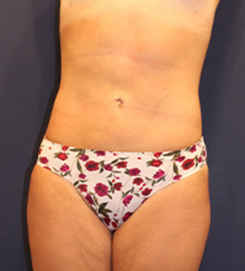 Liposuction Before & After