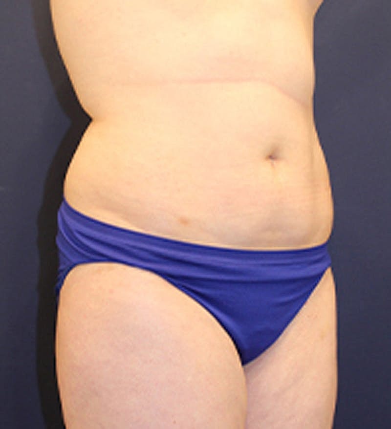 Liposuction Before & After