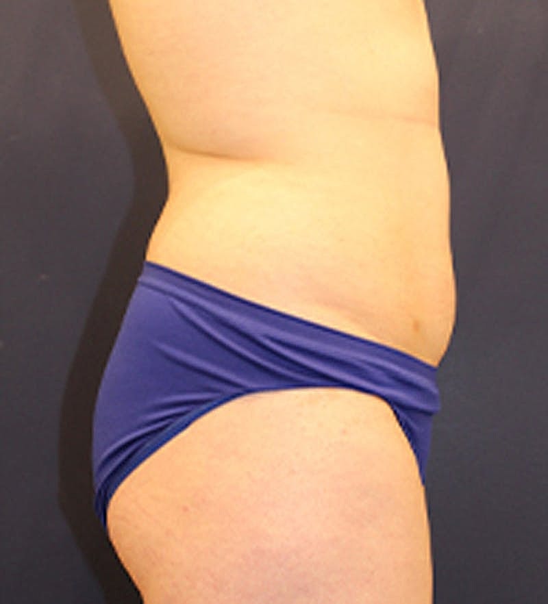 Liposuction Before & After