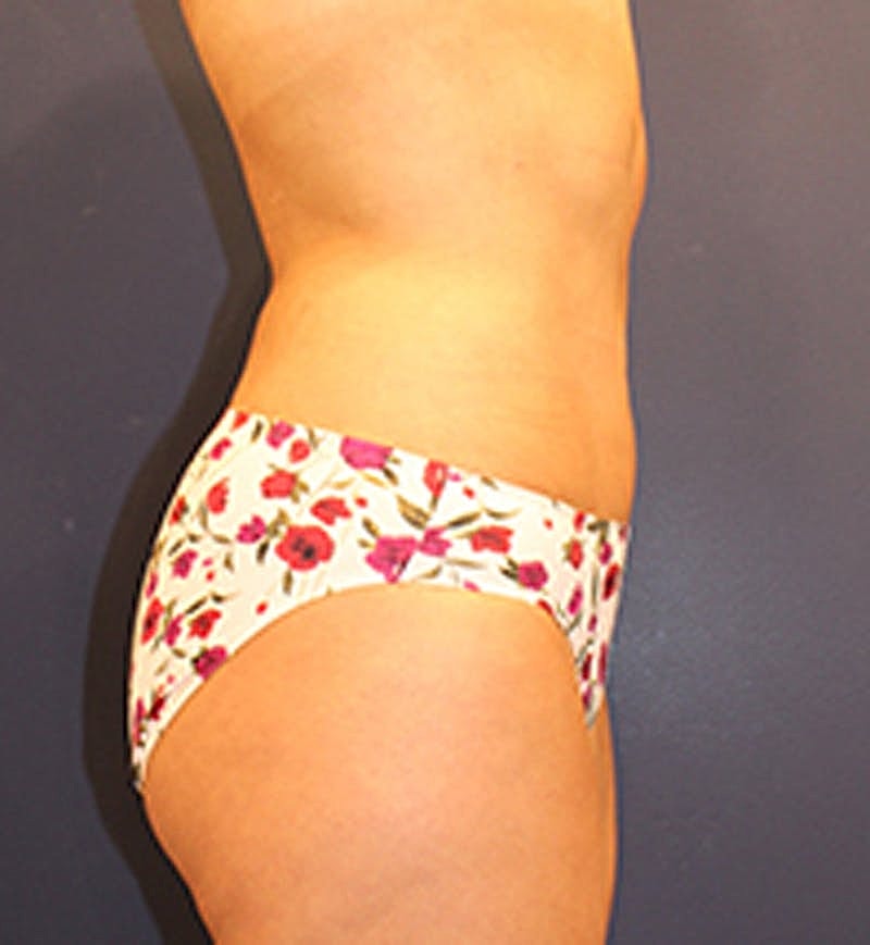 Liposuction Before & After