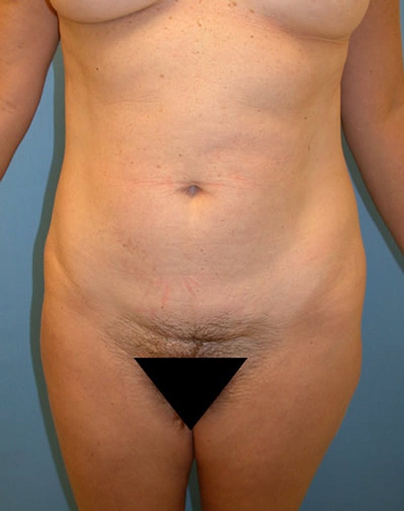 Liposuction Before & After