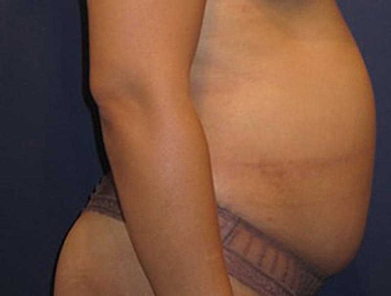 Liposuction Before & After