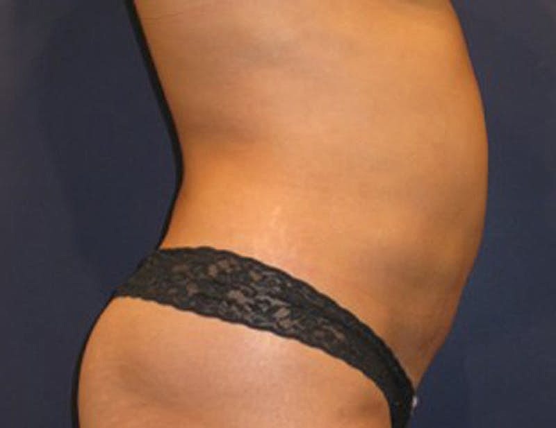 Liposuction Before & After