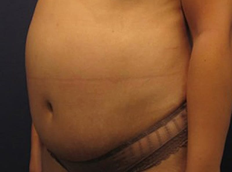 Liposuction Before & After