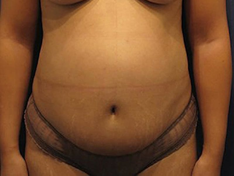 Liposuction Before & After