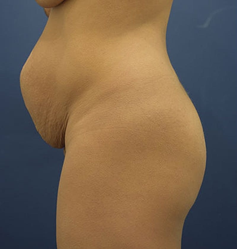 Liposuction Before & After