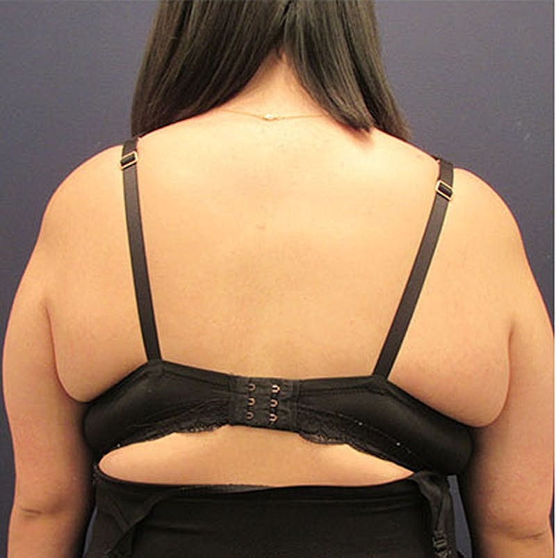 Liposuction Before & After