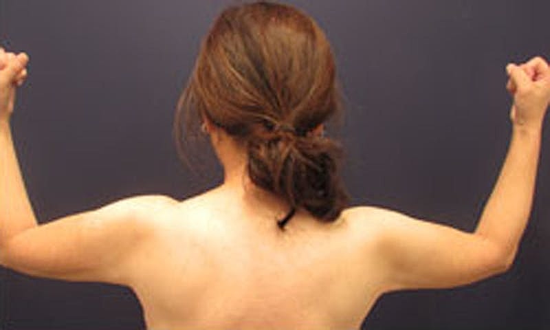 Liposuction Before & After