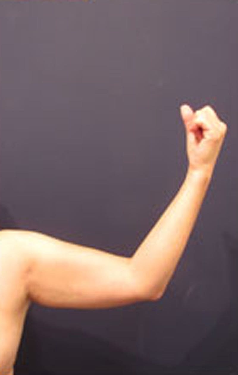 Liposuction Before & After