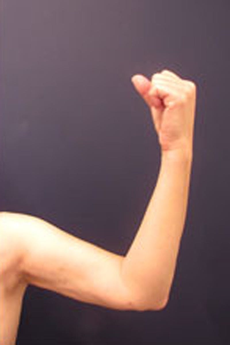 Liposuction Before & After