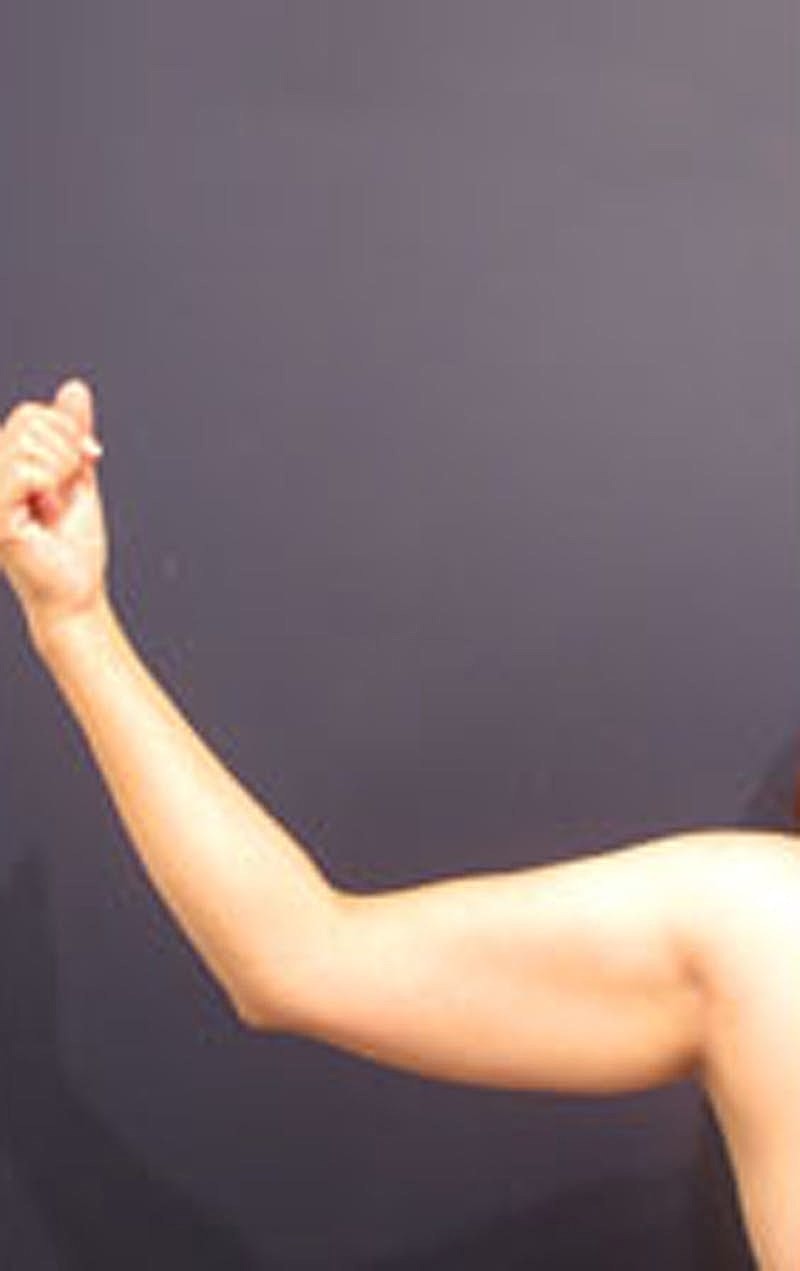 Liposuction Before & After