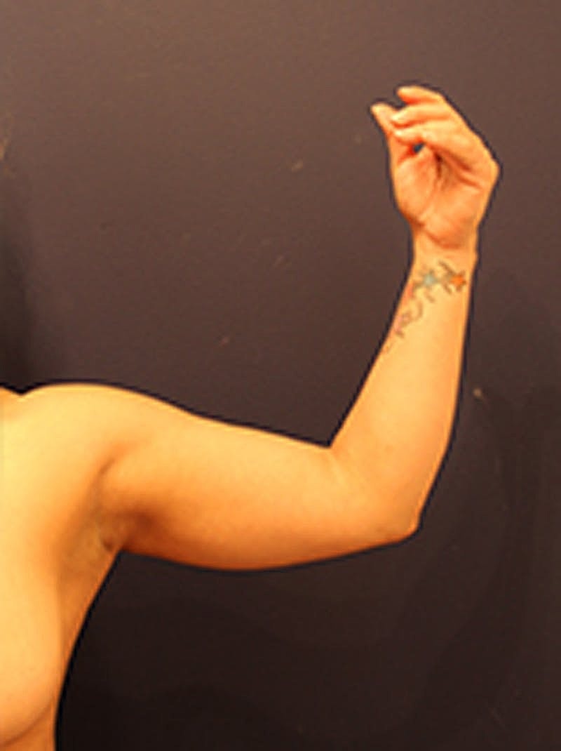 Liposuction Before & After