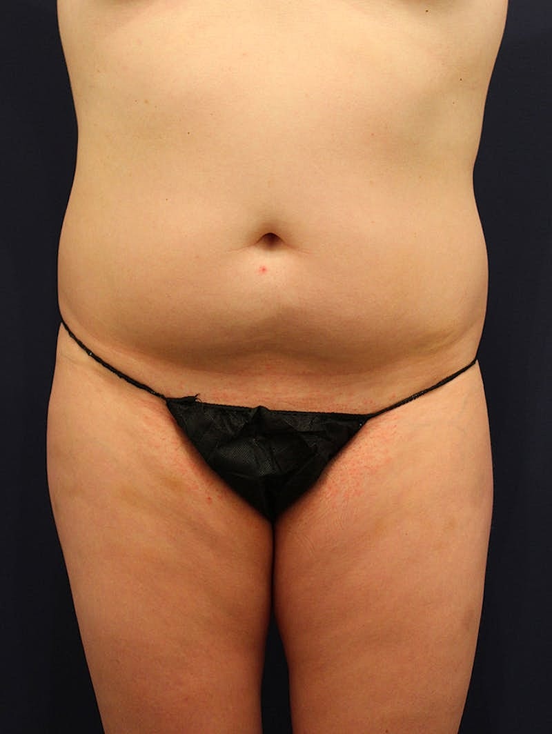 Liposuction Before & After