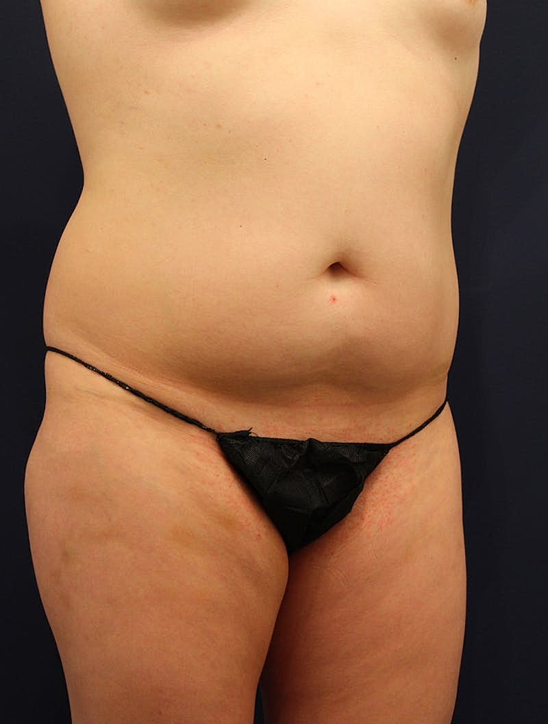 Liposuction Before & After