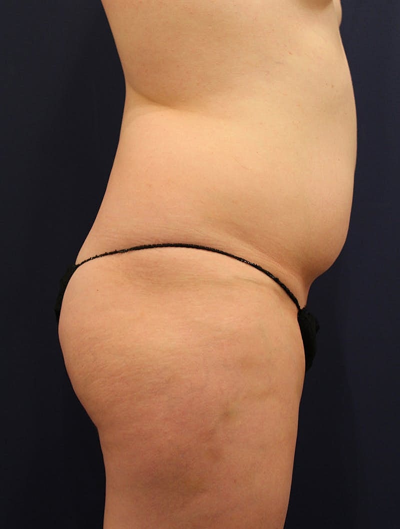 Liposuction Before & After