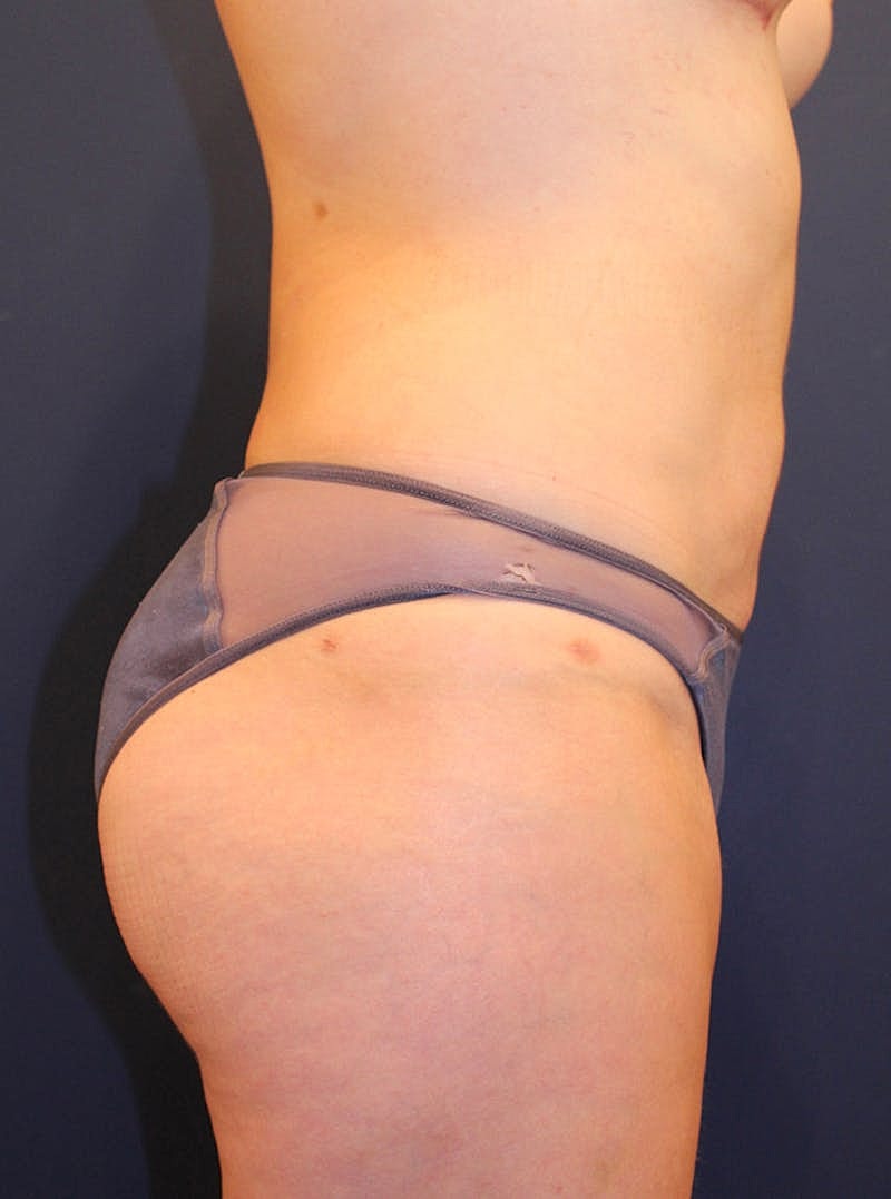 Liposuction Before & After