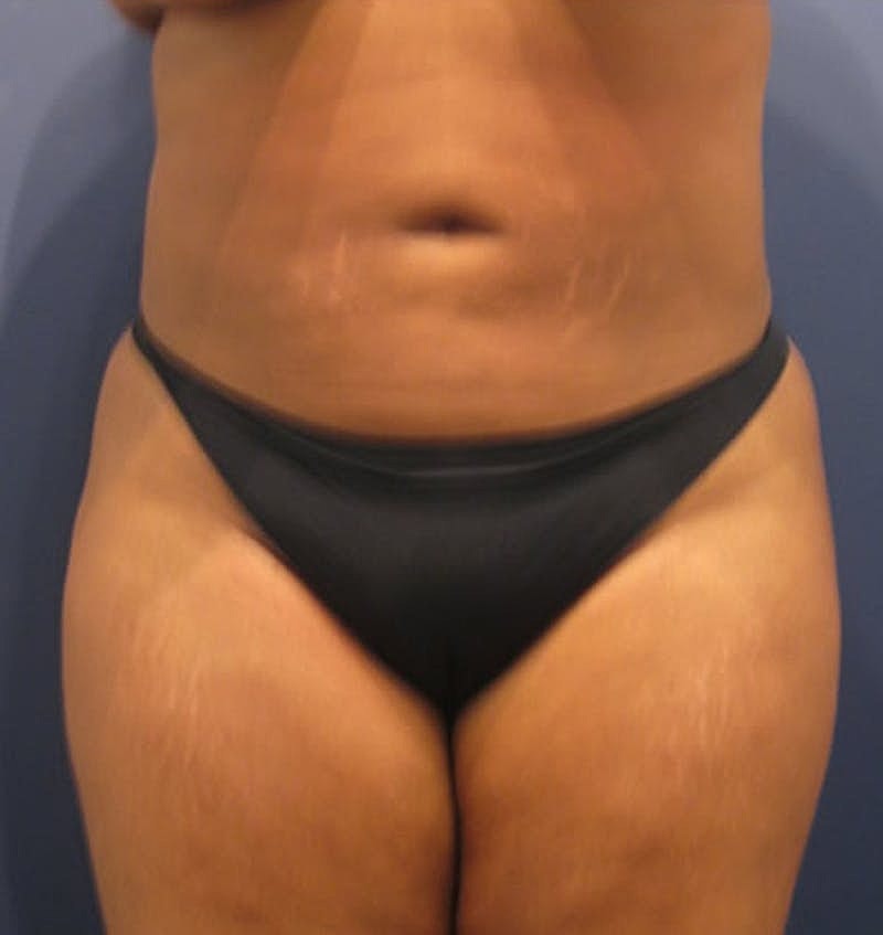 Liposuction Before & After