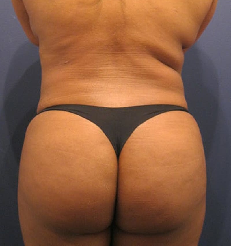 Liposuction Before & After